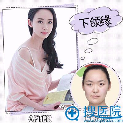 安徽韩美整形医院罗定安做的下颌角整形案例 安徽韩美整形医院罗定安做的下颌角整形案例