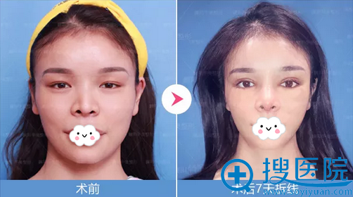钟磊软骨鼻综合眼综合术后效果 钟磊软骨鼻综合眼综合术后效果