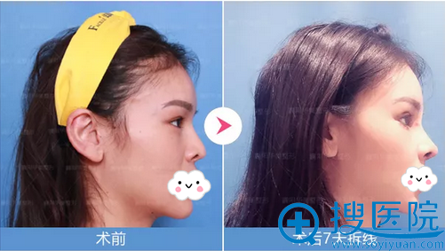 钟磊肋软骨鼻综合术后侧脸效果 钟磊肋软骨鼻综合术后侧脸效果