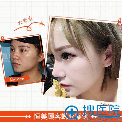 合肥恒美整形医院廖亚敏做的鼻综合隆鼻案例 合肥恒美整形医院廖亚敏做的鼻综合隆鼻案例