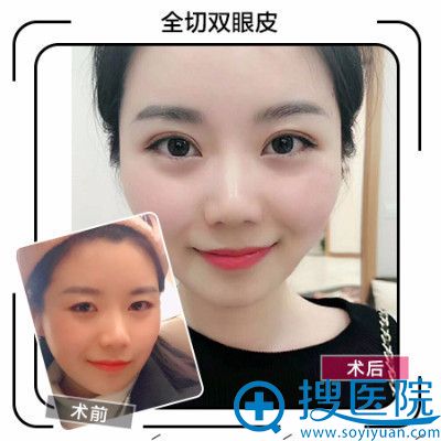 合肥华美朱德刚医生做的全切双眼皮案例 合肥华美朱德刚医生做的全切双眼皮案例