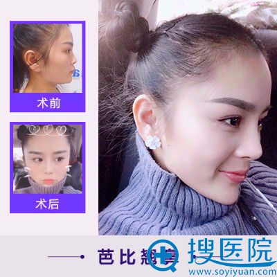 合肥崔劲松整形医院崔向葵做的隆鼻案例 合肥崔劲松整形医院崔向葵做的隆鼻案例