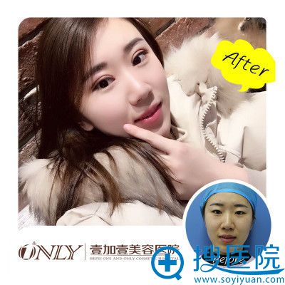 合肥壹加壹整形医院孟松医生做的双眼皮案例 合肥壹加壹整形医院孟松医生做的双眼皮案例