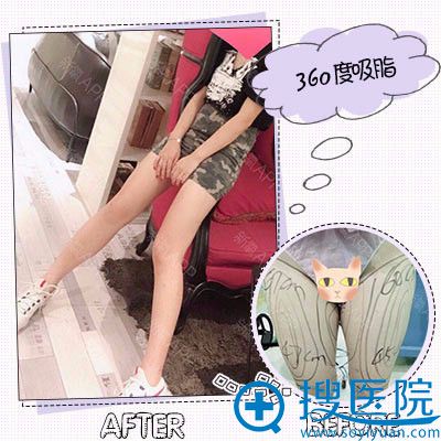合肥韩美闫品行做的大腿吸脂案例 合肥韩美闫品行做的大腿吸脂案例