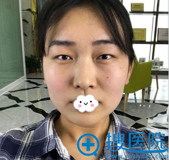 趁活动价格到武汉伊美馨做了灵韵精雕大眼术:切开双眼皮+开眼角
