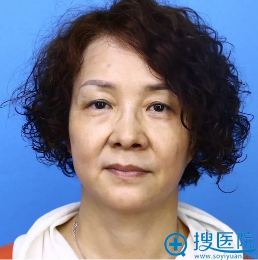 50岁的她找长春中研奥拉克陈继革做完面部线雕提升后年轻了10岁