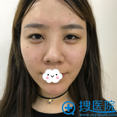 <!--<i data=20240710 data-id=11494></i>-->硅胶隆鼻术前照片 <!--<i data=20240710 data-id=11494></i>-->硅胶隆鼻术前照片