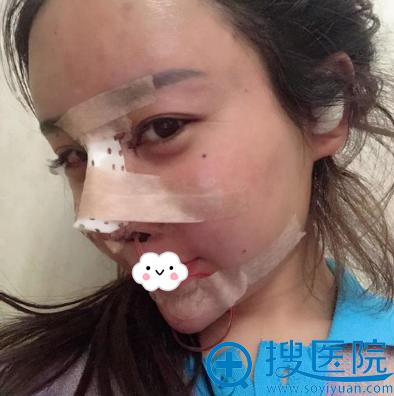 解学江硅胶隆鼻术后即刻照片 解学江硅胶隆鼻术后即刻照片
