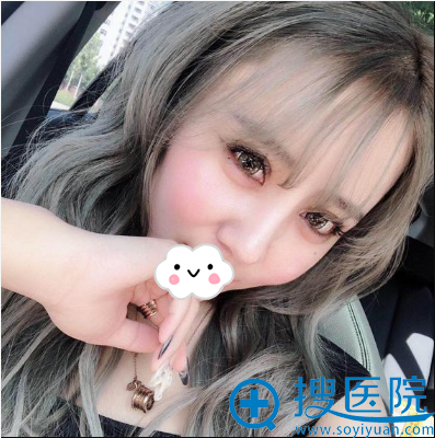 解学江假体+耳软骨综合隆鼻术后一个月效果 解学江假体+耳软骨综合隆鼻术后一个月效果
