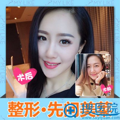 长沙美莱整形医院周文亮做的隆鼻案例 长沙美莱整形医院周文亮做的隆鼻案例
