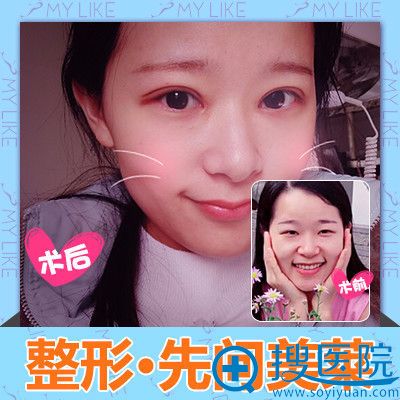 长沙美莱刘欢做的双眼皮案例 长沙美莱刘欢做的双眼皮案例