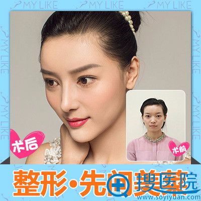 长沙美莱林彪斌V-LINE瓜子脸手术案例 长沙美莱林彪斌V-LINE瓜子脸手术案例