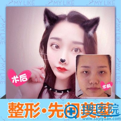长沙美莱<!--<i data=20240710 data-id=16271></i>-->文做的面部脂肪填充案例 长沙美莱<!--<i data=20240710 data-id=16271></i>-->文做的面部脂肪填充案例