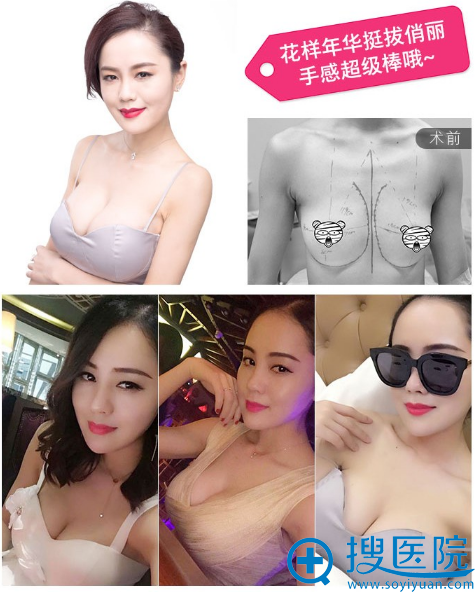 长沙雅美整形医院<!--<i data=20240710 data-id=16737></i>-->做的假体隆胸案例 长沙雅美整形医院<!--<i data=20240710 data-id=16737></i>-->做的假体隆胸案例