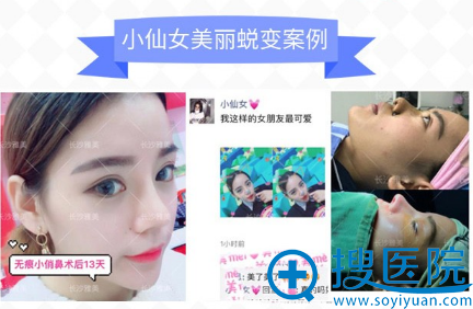 长沙雅美田芳斌做的隆鼻案例图 长沙雅美田芳斌做的隆鼻案例图