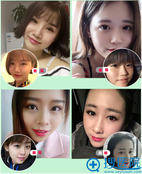 长沙雅美刘志刚做的双眼皮案例 长沙雅美刘志刚做的双眼皮案例