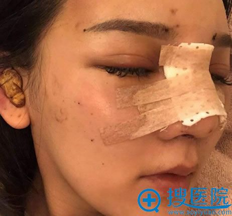 刚做完鼻修复手术的图片 刚做完鼻修复手术的图片