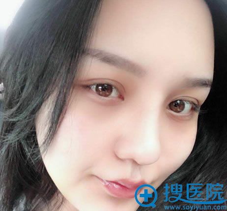 做完鼻修复和脂肪填充8天效果 做完鼻修复和脂肪填充8天效果