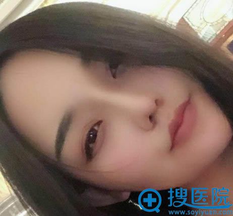 <!--<i data=20240710 data-id=11988></i>-->王光辉鼻修复案例30天效果 <!--<i data=20240710 data-id=11988></i>-->王光辉鼻修复案例30天效果