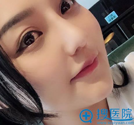做完鼻综合修复手术3个月恢复照 做完鼻综合修复手术3个月恢复照