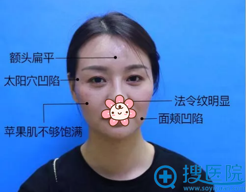看面部凹陷的她在深圳美加美做自体脂肪面部填充变成元气美少女