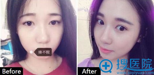 <!--<i data=20240710 data-id=13695></i>-->整形美容诊所王海峰做的双眼皮案例 <!--<i data=20240710 data-id=13695></i>-->整形美容诊所王海峰做的双眼皮案例