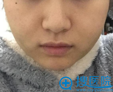 长沙健丽美臣张继平怎么样?脸大的我很满意面部吸脂术后效果