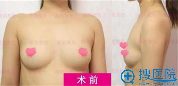 长沙丰胸哪家医院好?看长沙雅美肖征刚给我做得假体隆胸就挺好
