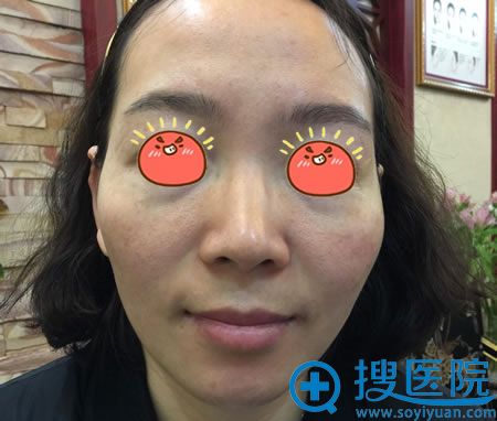 北京脂肪填充哪家好?用我的亲身经历告诉你北京京韩张振很不错