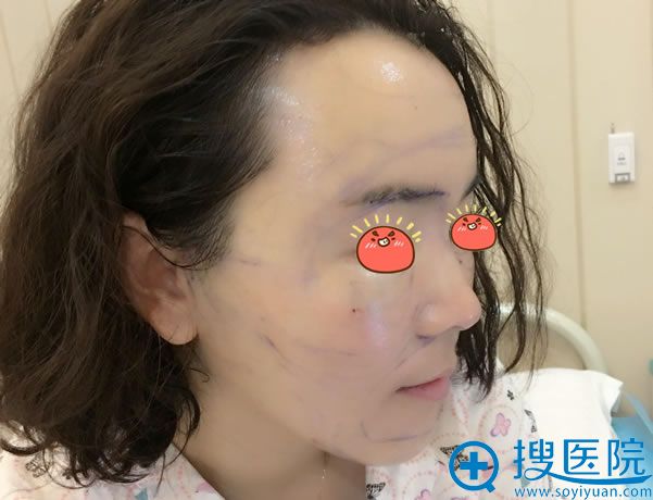 在京韩刚做完自体脂肪填充图片 在京韩刚做完自体脂肪填充图片