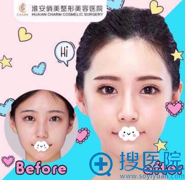 淮安俏美(原<!--<i data=20240710 data-id=1747></i>-->整形外科朱晓云)双眼皮案例 淮安俏美(原<!--<i data=20240710 data-id=1747></i>-->整形外科朱晓云)双眼皮案例