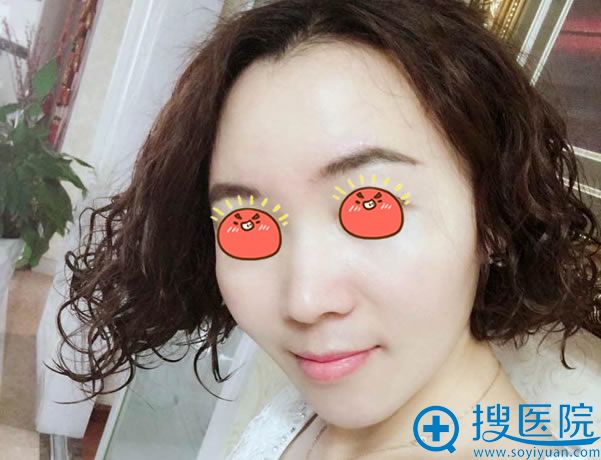 北京京韩张振脂肪填充案例30天效果 北京京韩张振脂肪填充案例30天效果