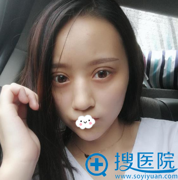 我让成都成美冯春雨做假体隆鼻整形听说可以约鼻修复医生李承浩