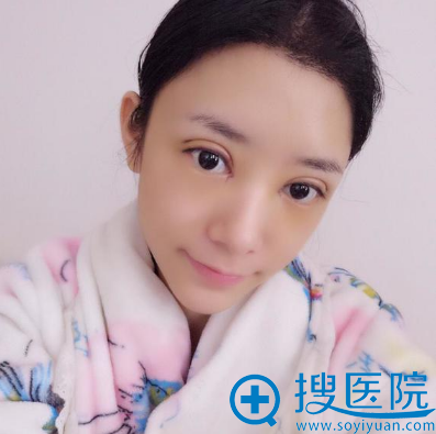 西安维美大眼睛整形医院双眼皮案例术后第二天 西安维美大眼睛整形医院双眼皮案例术后第二天