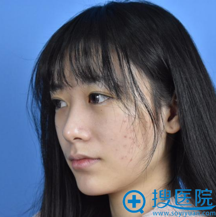 在西安维美大眼睛整形医院做双眼皮前 在西安维美大眼睛整形医院做双眼皮前