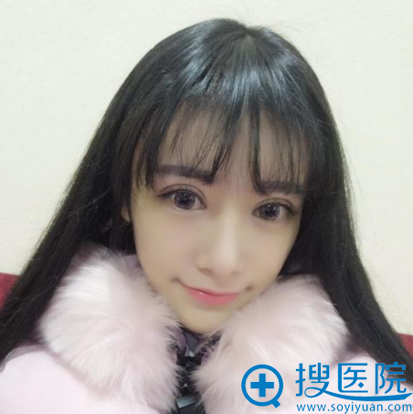西安维美大眼睛整形医院许依曼双眼皮案例7天效果图 西安维美大眼睛整形医院许依曼双眼皮案例7天效果图