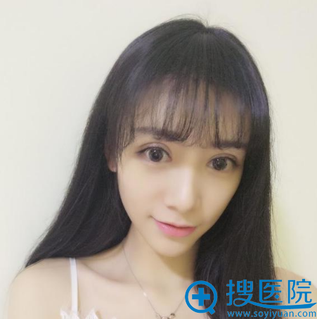在西安维美大眼睛整形医院割完双眼皮15天 在西安维美大眼睛整形医院割完双眼皮15天