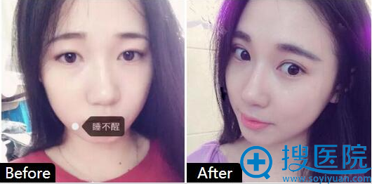 赣州长安整形美容医院周伟双眼皮案例 赣州长安整形美容医院周伟双眼皮案例