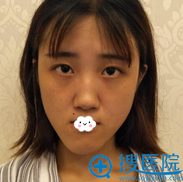 重庆爱思特整形美容医院高伟面部畸形改下颌角案例 重庆爱思特整形美容医院高伟面部畸形改下颌角案例