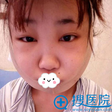 重庆爱思特高伟下颌角整形术后效果 重庆爱思特高伟下颌角整形术后效果