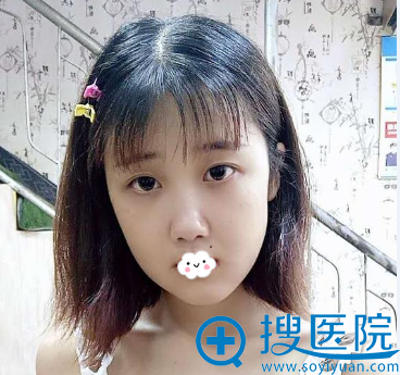 重庆爱思特高伟面部畸形矫正术后效果 重庆爱思特高伟面部畸形矫正术后效果