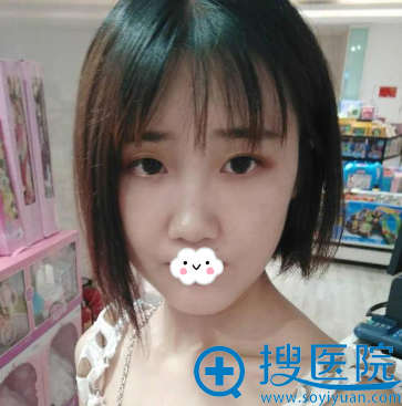 重庆爱思特下颌角磨骨整形真人案例 重庆爱思特下颌角磨骨整形真人案例