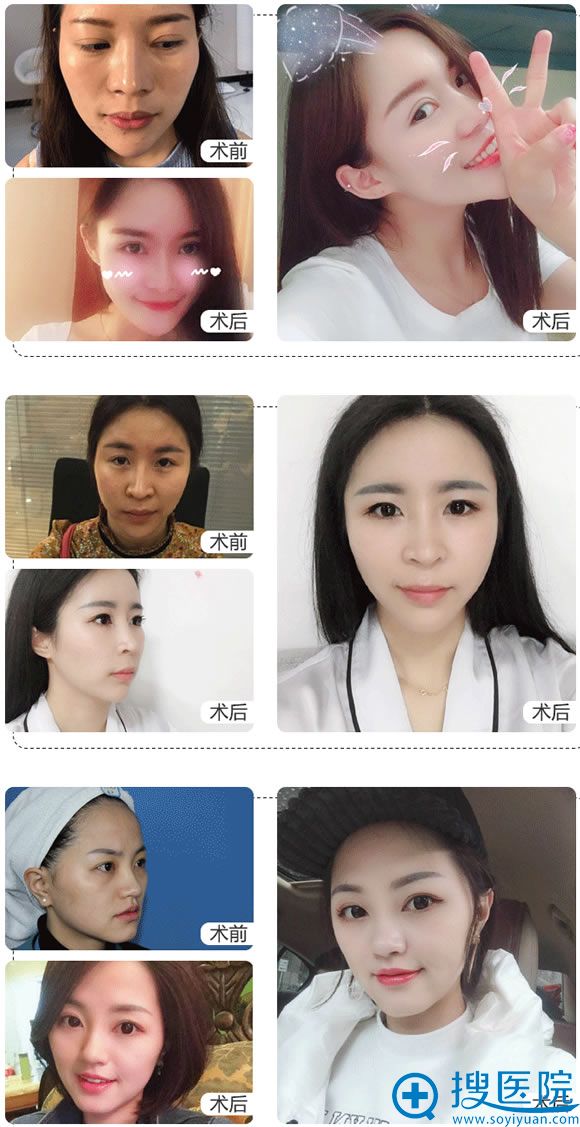 重庆爱思特自体脂肪填充案例 重庆爱思特自体脂肪填充案例