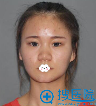 同学到宁夏华美割双眼皮效果挺好让我找<!--<i data=20240710 data-id=16566></i>-->斐做鼻综合隆鼻整形真人案例 同学到宁夏华美割双眼皮效果挺好让我找<!--<i data=20240710 data-id=16566></i>-->斐做鼻综合隆鼻整形真人案例
