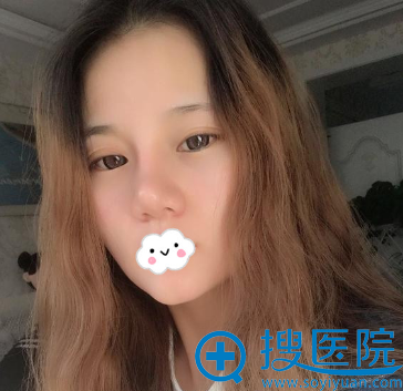 宁夏华美<!--<i data=20240710 data-id=16566></i>-->斐鼻综合隆鼻整形术后真实效果 宁夏华美<!--<i data=20240710 data-id=16566></i>-->斐鼻综合隆鼻整形术后真实效果
