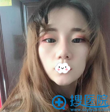 宁夏隆鼻哪家好?宁夏华美<!--<i data=20240710 data-id=16566></i>-->斐鼻综合隆鼻整形案例 宁夏隆鼻哪家好?宁夏华美<!--<i data=20240710 data-id=16566></i>-->斐鼻综合隆鼻整形案例