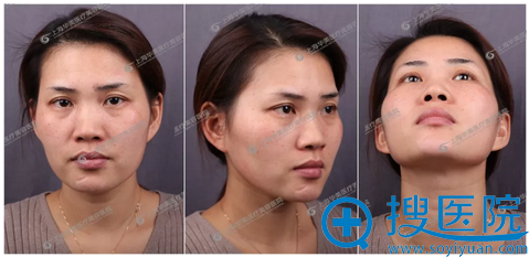 用我的亲身经历告诉你上海华美杨亚益做双眼皮修复怎么样
