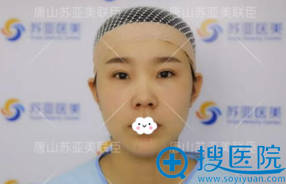 我执拗的认为到唐山美联臣做的耳软骨综合隆鼻整形效果挺好!
