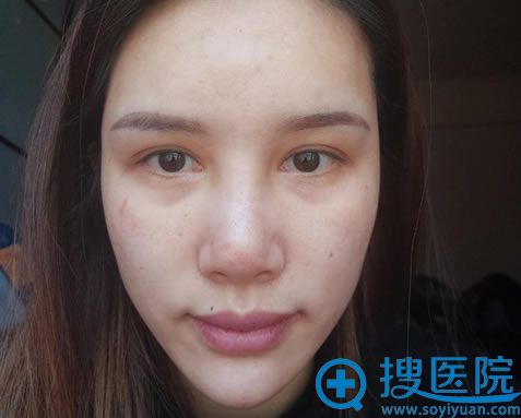 膨体隆鼻感染取出鼻子假体,打玻尿酸又变宽鼻,现在终于修复好啦