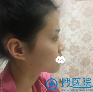 我与闺蜜到无锡米兰整形医院王忠志处做鼻综合隆鼻和双眼皮1周
